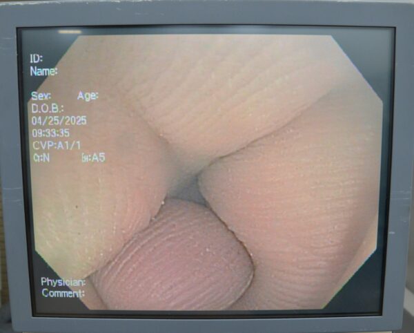 Olympus Evis Exera II PCF-H180AL Video Laryngoscope