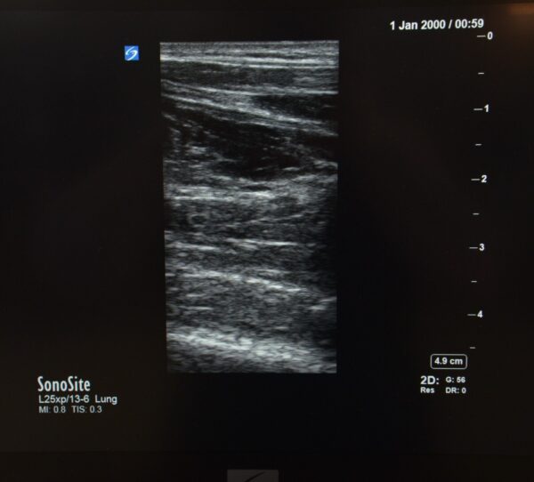 FujiFilm SonoSite X-Porte L25xp/13-6 MHz Linear Array Ultrasound Transducer P14566-20