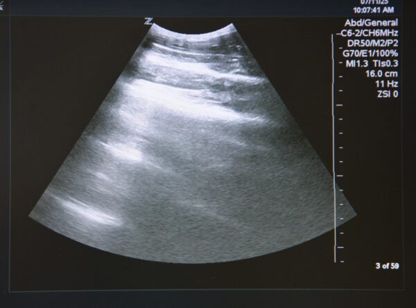 Zonare Ultra Z.one Diagnostic Ultrasound System W/ C6-2 Transducer, L10-5 Transducer, Z.one Scan Engine & SmartCart